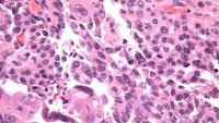 Ovarian cancer - high grade serous carcinoma of tubo-ovarian origin