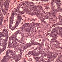 Research slide of endometrial cancer.